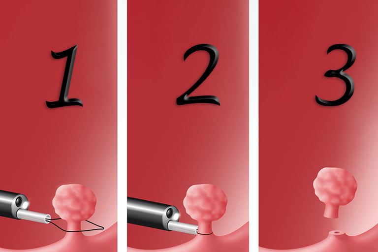 La chirurgie des polypes