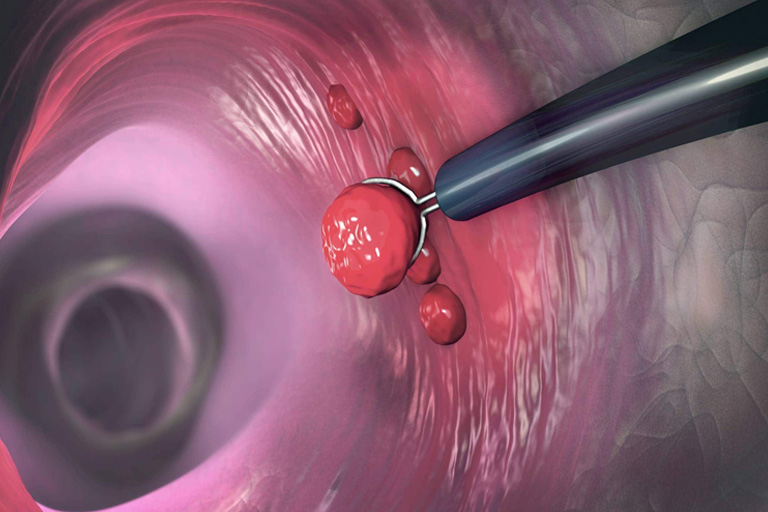 La chirurgie des polypes