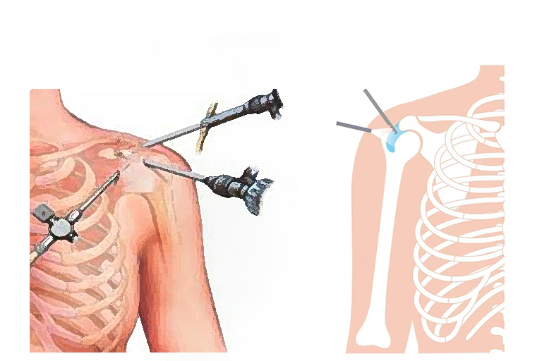 chirurgie de l’épaule