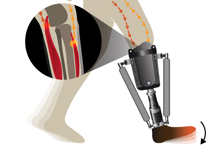Prothèses Orthopédiques Sur Mesure