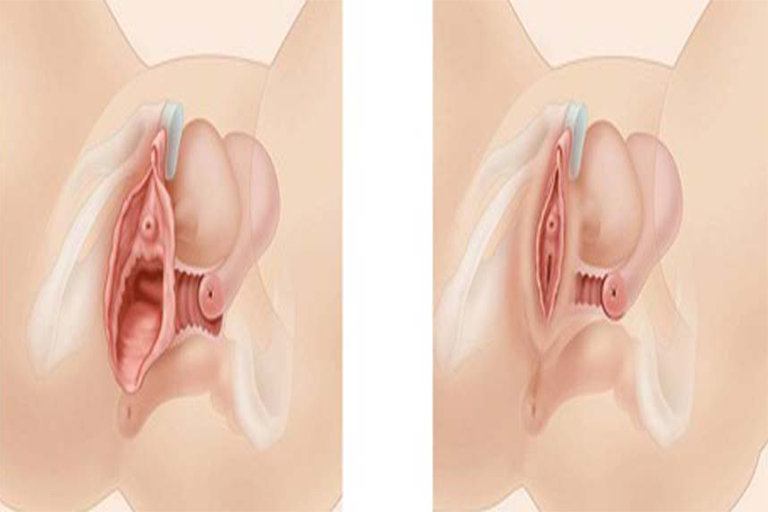 Vaginoplastie