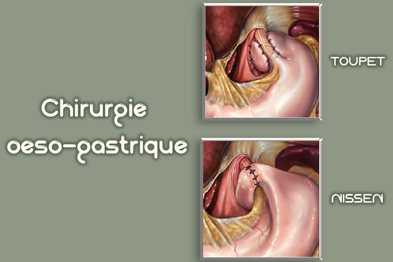 chirurgie oeso-gastrique
