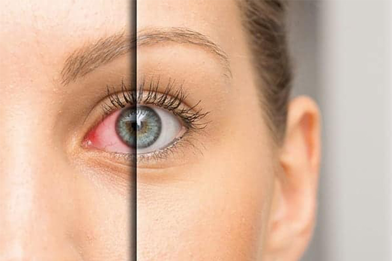 La chirurgie du glaucome