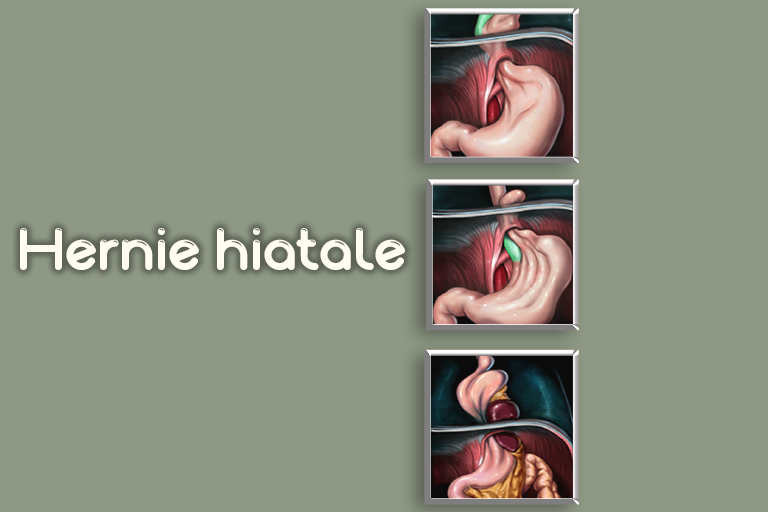 chirurgie oeso-gastrique