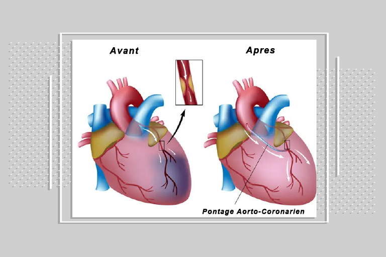 pontage aorto coronarien