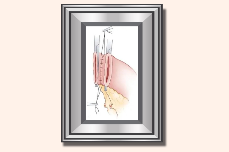 Résection de l'intestin grêle