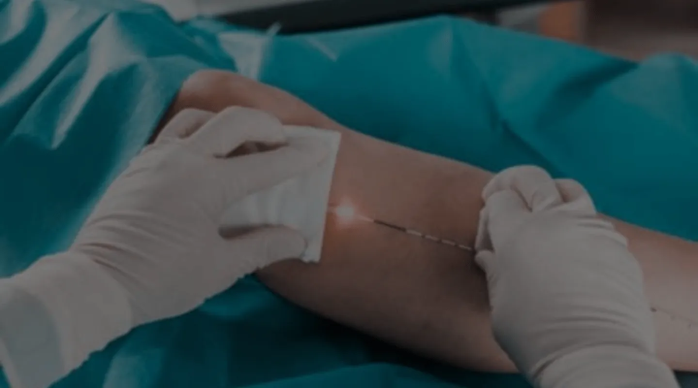 Laser endoveineux