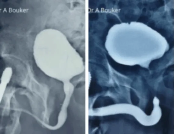Uretroplastie